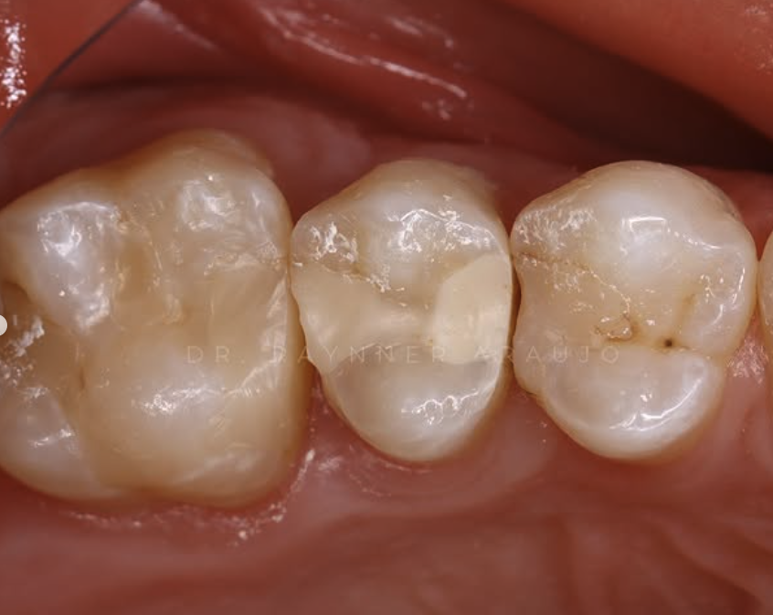 Restaurações posteriores em resina com anatomia detalhada