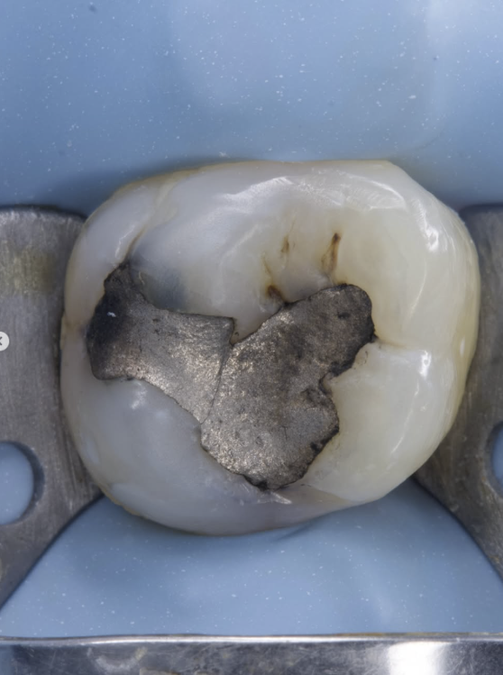 Antes: restauração de amálgama em dente posterior